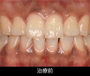 歯肉ピーリング