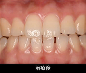 歯肉ピーリング